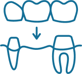 Dental Bridges